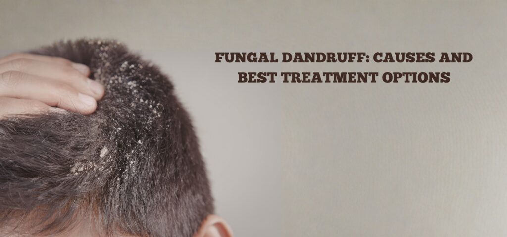 Fungal Dandruff Causes and Best Treatment Options